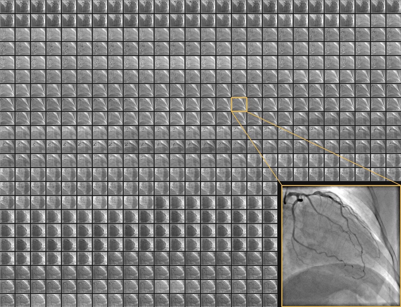 500 real angiogram frames of one patient in an even grid, one enlarged