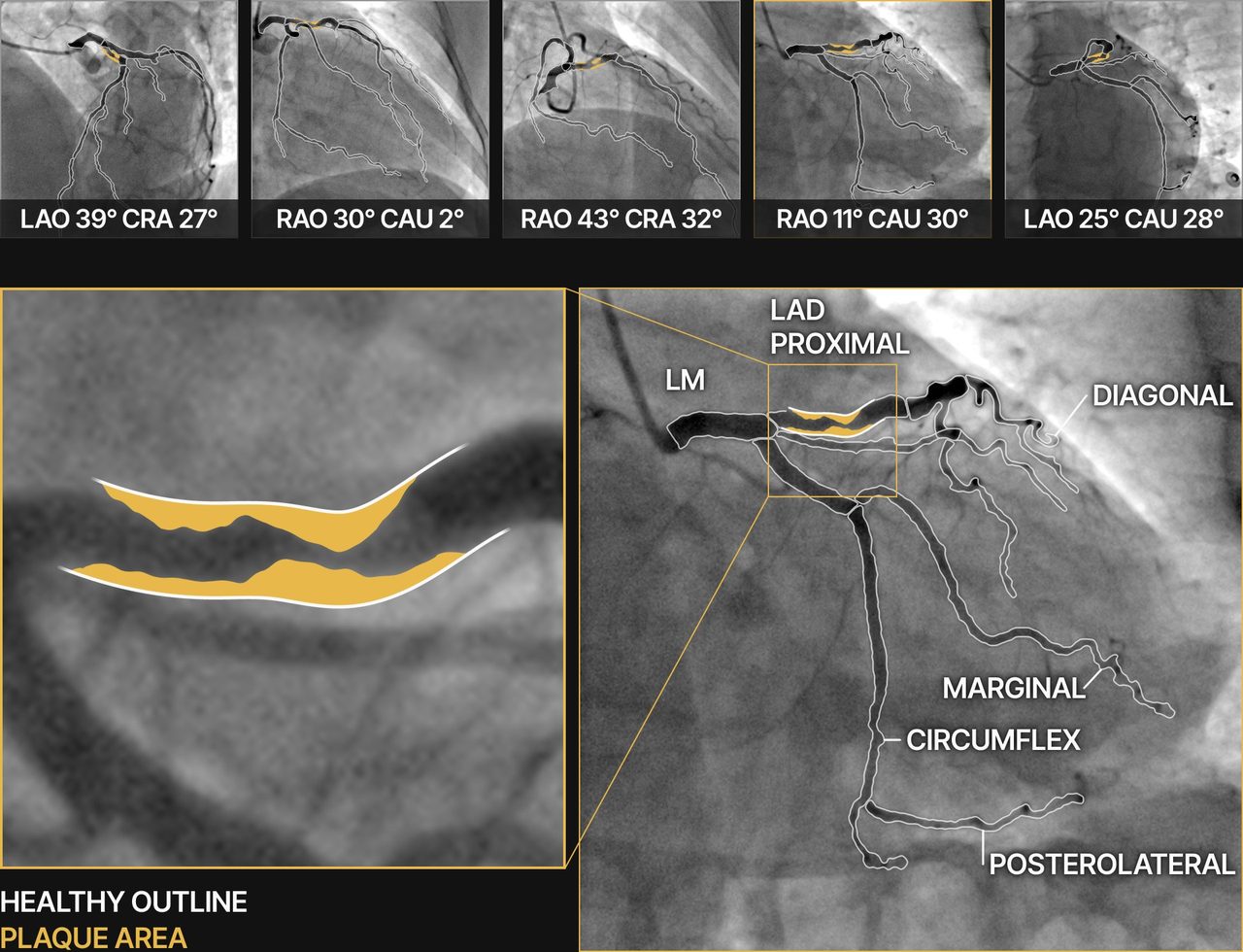 The picked frames read by CardioTwin: arteries named and the narrowing traced in amber
