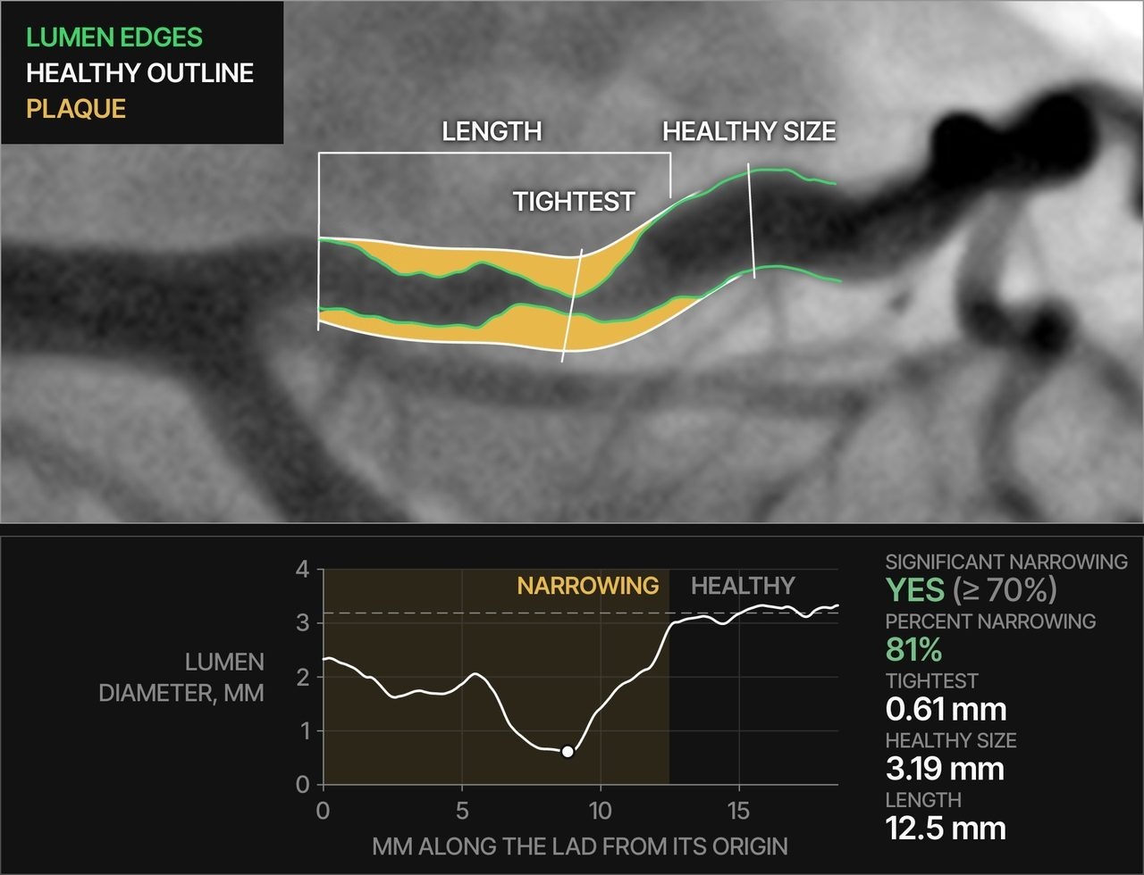 The narrowing measured: artery edges in green, healthy outline in white, plaque in amber, and the diameter curve with its numbers
