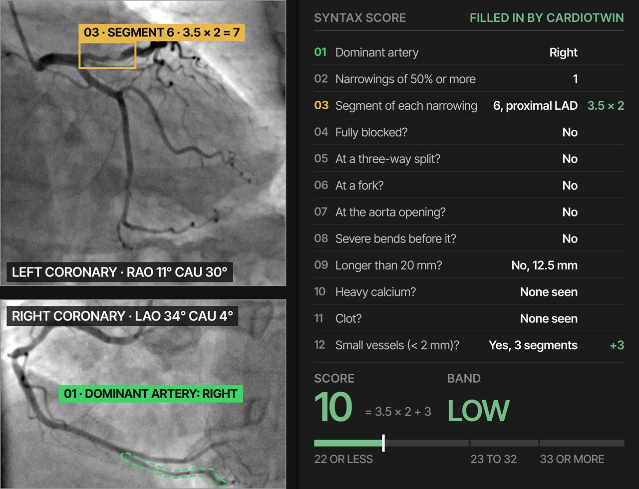 The SYNTAX score form filled in by CardioTwin from the films, with the score and band